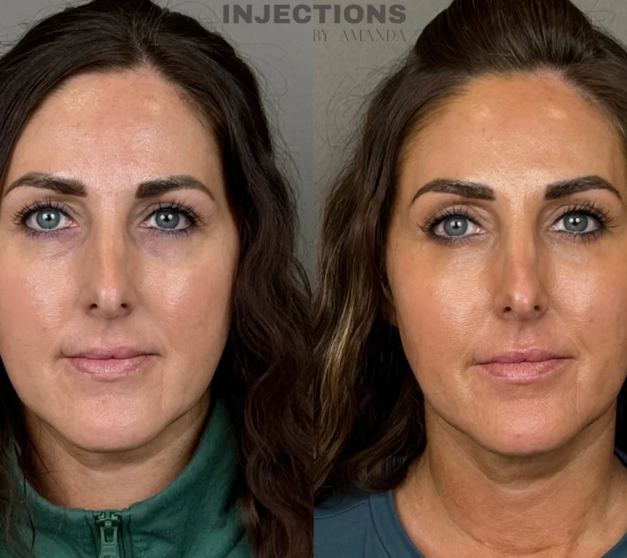 Under-Eye Treatment Before and After Images - 1 Under-Eye Treatment Before and After Images b