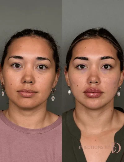 Youthful Essence Before and After Images - 16 Youthful Essence image (1)