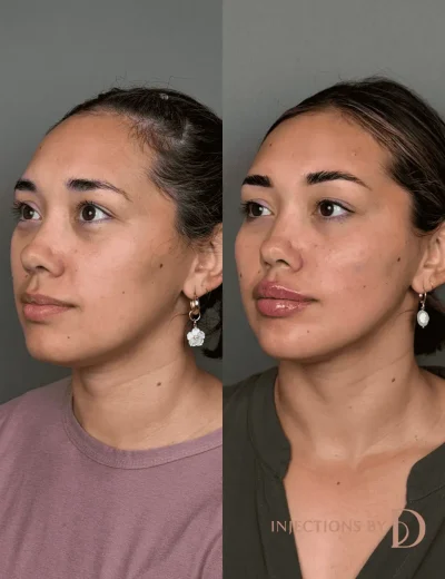 Youthful Essence Before and After Images - 18 Youthful Essence image (2)