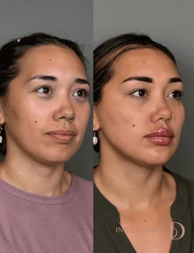 Youthful Essence Before and After Images - 17 Youthful Essence image (3)