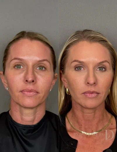 Youthful Essence Before and After Images - 22 Youthfull Essence a
