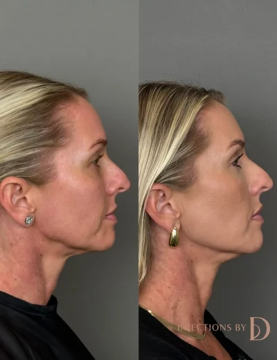 Youthful Essence Before and After Images - 21 Youthfull Essence