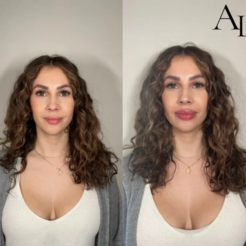 lip-before-after