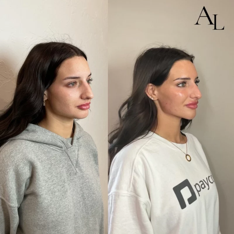 side-face-before-after